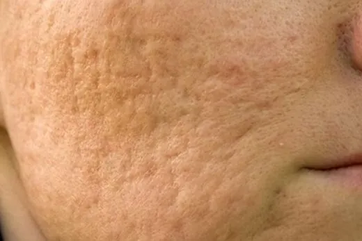Open Pores & Texture